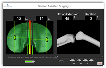 Implants From OrthoSensor to Monitor Knees for Load, Stability and ...